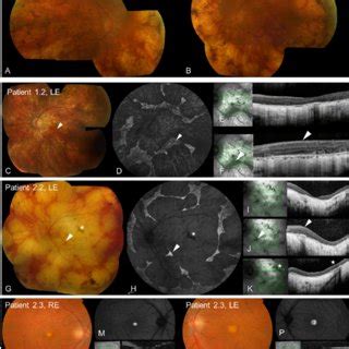 Retinal Imaging In Dominant Rpe Disease A B C G L O Color