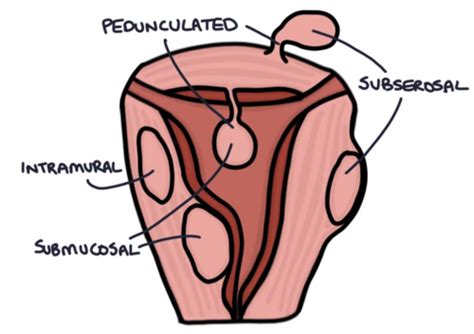 Fibroids Ovarian Cysts And Tumours Flashcards Quizlet