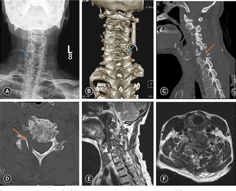 Figure 2 From Fully Endoscopic Posterior Cervical 2 Level Foraminotomy