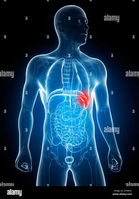 Spleen cancer, artwork Stock Photo - Alamy