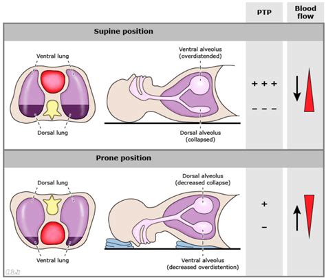 Prone-Positioning – Multi Trauma Critical Care Resources