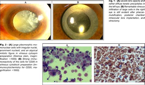 Figure 1 From Diagnostic Vitrectomy 25 Gauge In A Case With Intraocular Lymphoma Masquerading