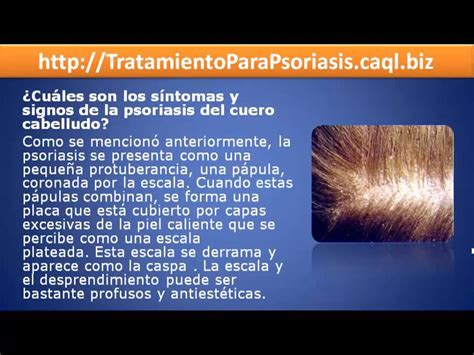 Posibles Causas Y Sintomas De Psoriasis En El Cuero Cabelludo Youtube