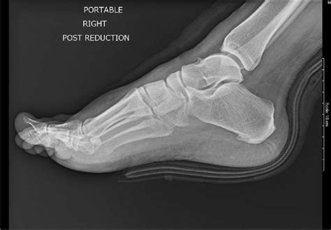 Lisfranc Fracture Dislocation Post Reduction Lateral View Showing Download Scientific