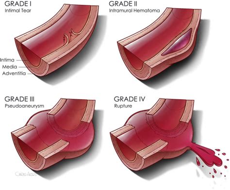 Best Of Aast Management Of Low Grade Blunt Thoracic Aortic Injury