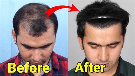 Unbelievable Hair Growth After Hair Transplant Best Hair Transplant