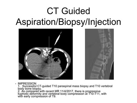 Discitis And Osteomyelitis In Sickle Cell Disease Ppt