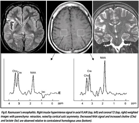 Scielo Brasil The Pattern Of Proton Magnetic Resonance Spectroscopy