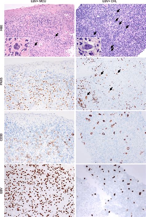 Histology Of EBV Mucocutaneous Ulcer EBV MCU Left Column And