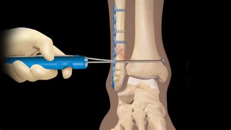 High Ankle Sprains OrthoPedia Patient