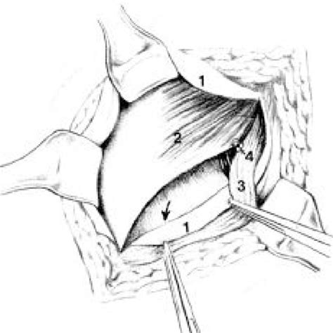 Inguinal Hernioplasty According To Lotheissen And Mcvay By Preparation