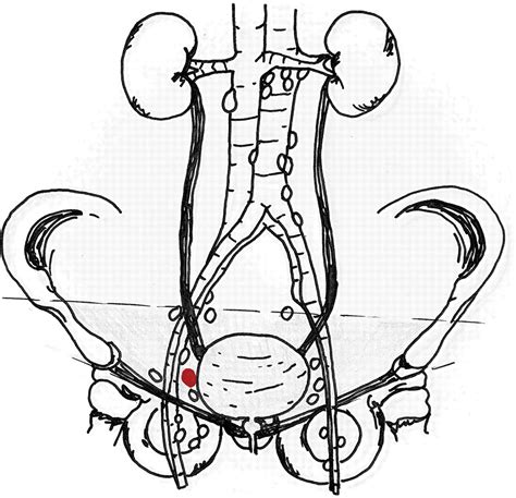 Pelvic Lymph Nodes Male