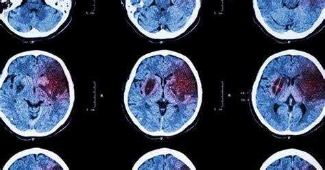 Derrame cerebral definición causas síntomas y tratamiento