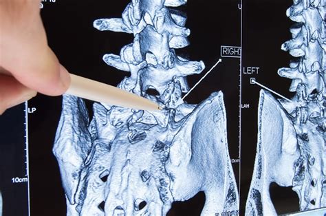 Learn About Minimally Invasive Spine Surgery