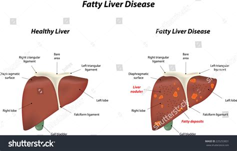 Fatty Liver Disease Stock Photo 225253831 : Shutterstock