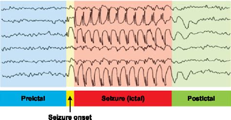 Figure 1 From Extracting And Selecting Distinctive EEG Features For