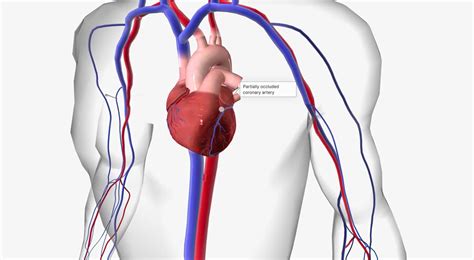 Premium Photo | Angina is chest pain or discomfort due to reduced blood flow to the heart