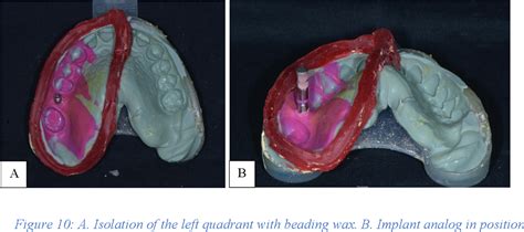 Figure 1 From Accuracy Of Digital Impressions At Varying Implant Depths