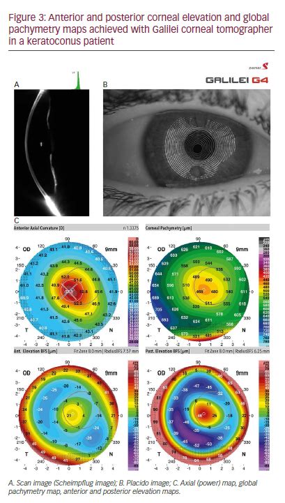 Keratoconus Screening In Primary Eye Care A General Overview