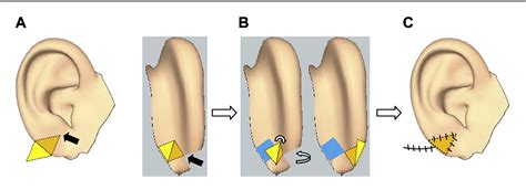 Figure 1 From Postauricular Flap Based On Dermal Pedicle For