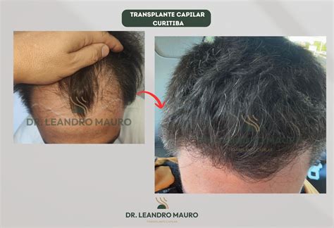 Transplante Capilar Em 36x - Diagnóstico ao Resultado Final: Como Funciona o Transplante Capilar em ...