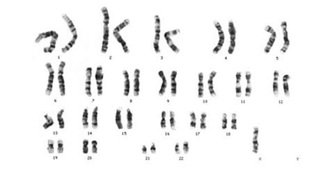 Sindrome De Turn