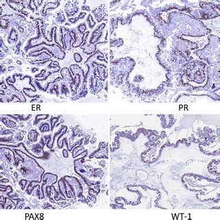 Immunohistochemical Staining Showed That The Tumor Cells Expressed High