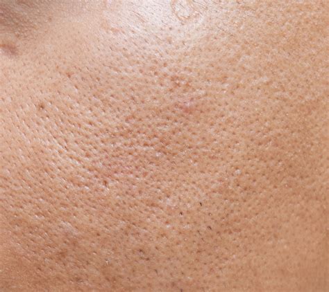 How I Finally Cleared My Closed Comedones – Derma Drink