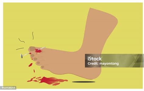 Cedera Kaki Ilustrasi Stok Unduh Gambar Sekarang Luka Ponction