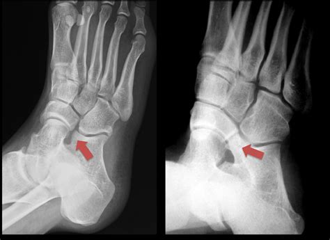 Tarsal Coalition Surgery And Treatment Naples Miami Florida And New
