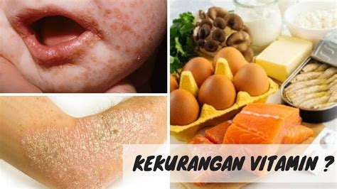 Inilah 5 Gejala Tubuh Kekurangan Vitamin Atau Mineral Tertentu Youtube