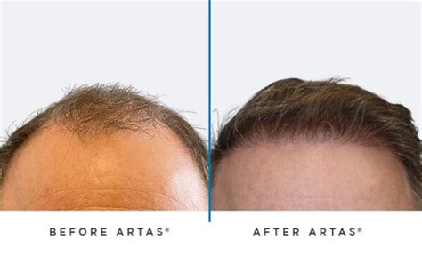 ARTAS Robotic Hair Transplant Restoration Clinic In Austin