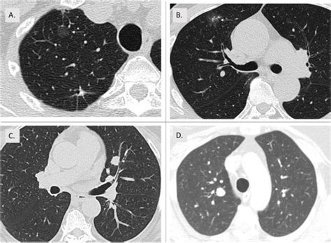 High Risk Lung Nodule A Multidisciplinary Approach To Diagnosis And