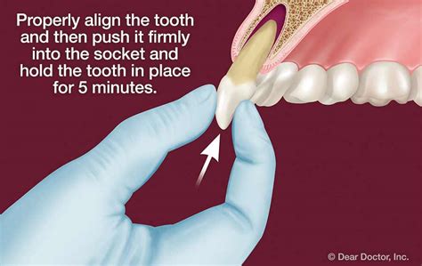 Traumatic Dental Injuries Joseph Hudgins Orthodontics Carbondale