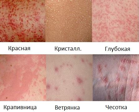 Сыпь на бедрах у ребенка: причины, виды, диагностика и лечение