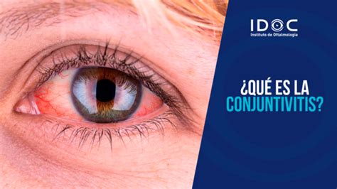 Conjuntivitis Idoc Cirugía Lasik Cataratas Y Carnosidades