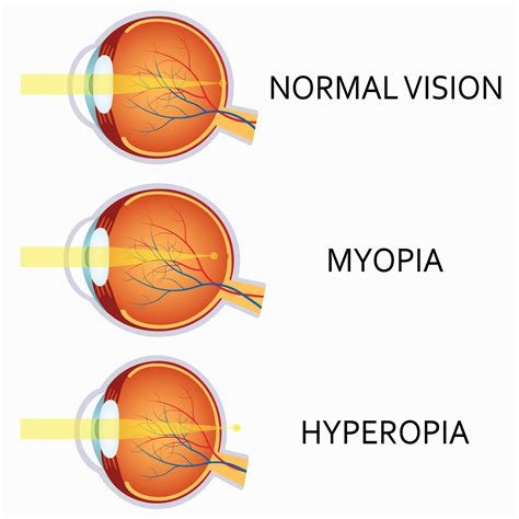 Myopia Hyperopia Diagram Loden Ivision Center