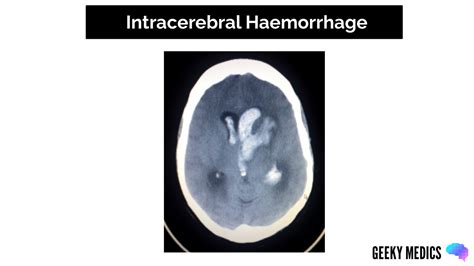 Types Of Intracranial Haemorrhage Bleeds Geeky Medics