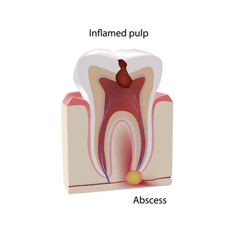 Emergency Dental Abscess Treatment Emergency Dentist London