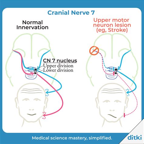 To Learn About Facial Palsy See The Full Tutorial Https