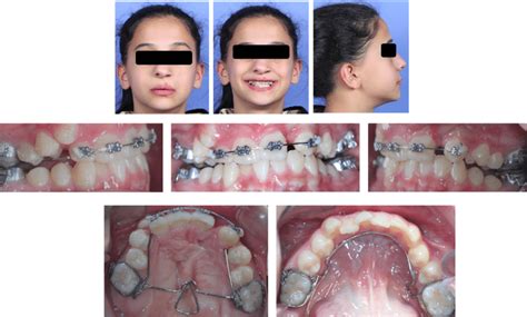 Appearance Of Anterior Brackets And Custom Made Transpalatal Arch