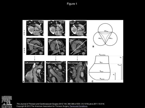 Restricted Cusp Motion In Right Left Type Of Bicuspid Aortic Valves A