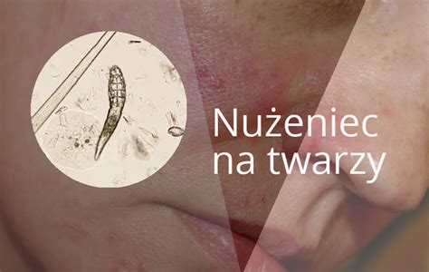 Nużeniec na twarzy sprawdź co warto wiedzieć ePiotrkow pl