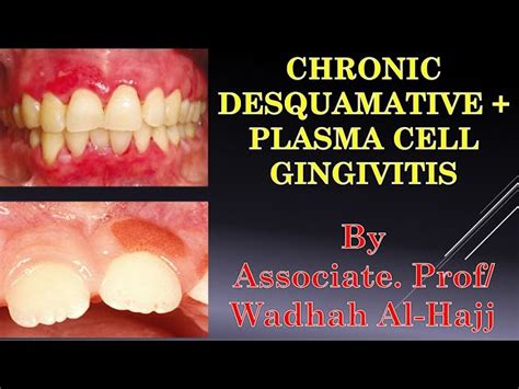 Plasma Cell Gingivitis