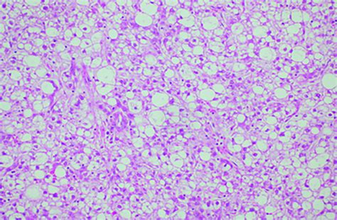 Variant Hepatocellular Carcinoma Subtypes According To The 2019 Who Classification An Imaging