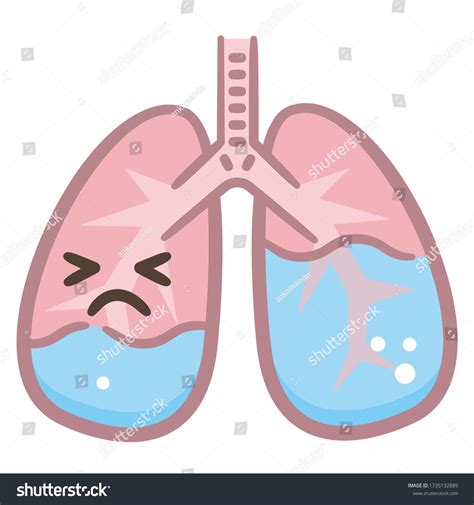 Pulmonary Edema Lung Disease Diagram Bronchi Stock Vector Royalty Free