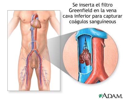 MedlinePlus Enciclopedia Médica Trombosis venosa Serie Procedimiento