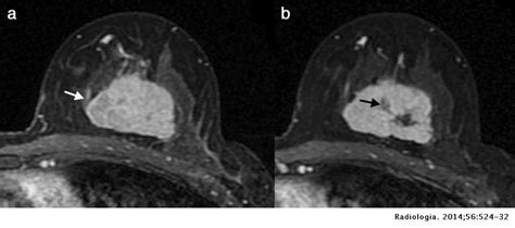 Resonancia Magnética En El Cáncer De Mama Tratado Con Neoadyuvancia Correlación Radiopatológica