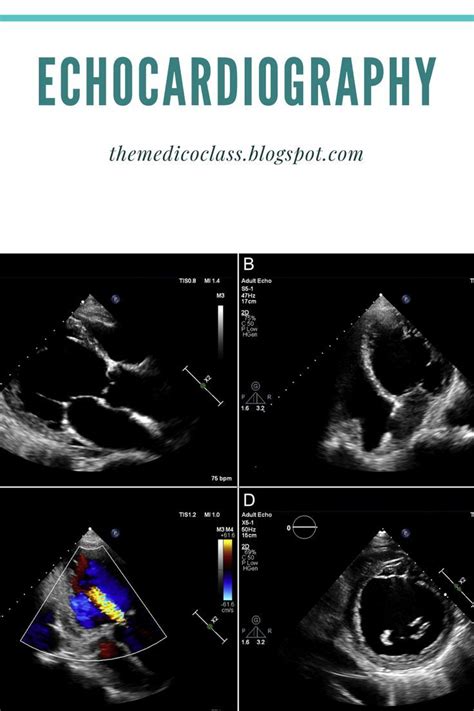 Echocardiography Views