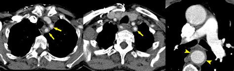 Giant Cell Arteritis Ct Radiology At St Vincent S University Hospital